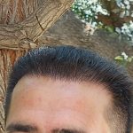 کاشت مو و ابرو در شیراز بصورت شرایطی