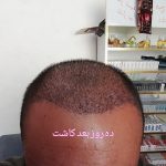 کاشت مو و ابرو در شیراز بصورت شرایطی