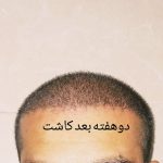 کاشت مو و ابرو در شیراز بصورت شرایطی