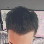 کاشت مو و ابرو در شیراز بصورت شرایطی