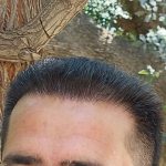 کاشت مو و ابرو  شیراز بصورت شرایطی