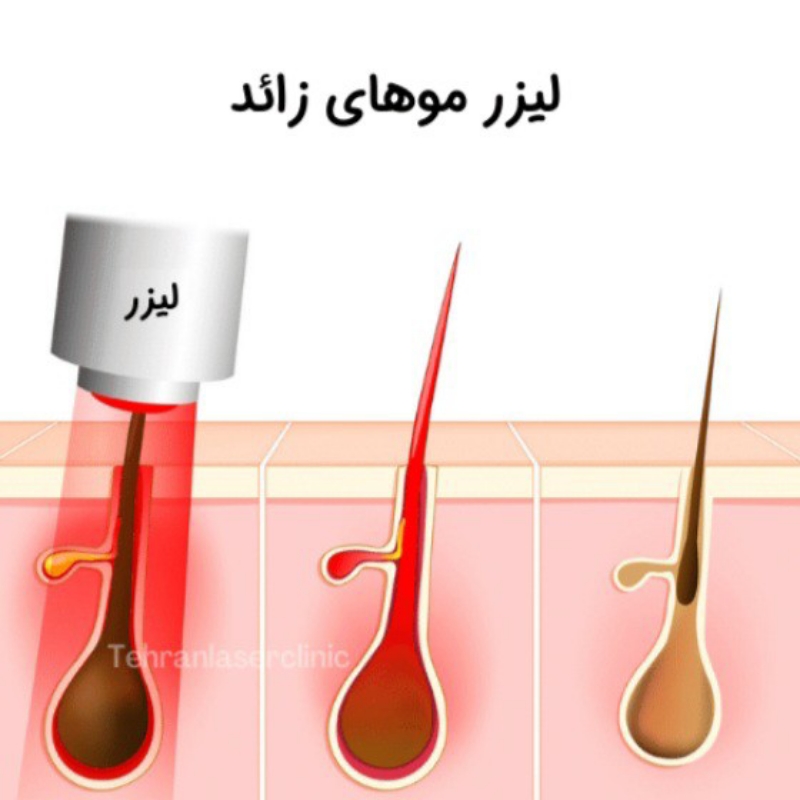 تزریق ژل بوتاکس