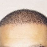 کاشت مو و ابرو  شیراز بصورت شرایطی