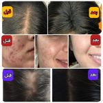 درمان قطعی کبد چرب