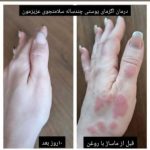 درمان قطعی کبد چرب