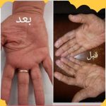 درمان قطعی کبد چرب