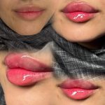 🌟 زیبایی طبیعی شما در دستان ماست! 🌟 رفع کامل چروک با بوتاکس | حجم‌دهی حرفه‌ای لب و گونه