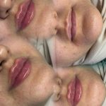 🌟 زیبایی طبیعی شما در دستان ماست! 🌟 رفع کامل چروک با بوتاکس | حجم‌دهی حرفه‌ای لب و گونه