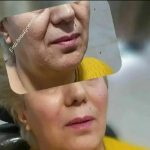 جشنواره تزریق ژل و بوتاکس
