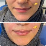 تزریق ژل و بوتاکس برای خانم ها و آقایان