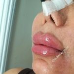 جشنواره تزریق ژل و بوتاکس