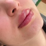 تزریق ژل و بوتاکس برای خانم ها و آقایان