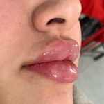 تزریق ژل و بوتاکس برای خانم ها و آقایان