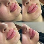 تزریق ژل و بوتاکس برای خانم ها و آقایان