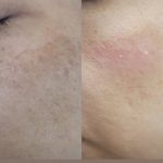 فیشال تخصصی و اسکالپ اسکراب سر