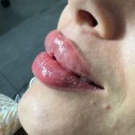 تزریق ژل و بوتاکس برای خانم ها و آقایان