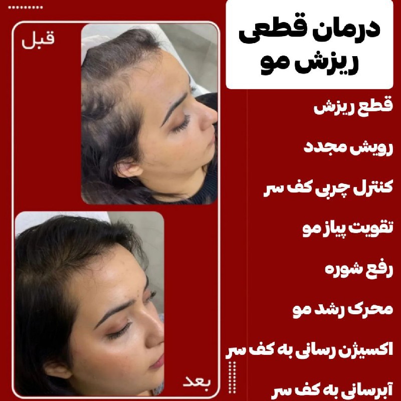 ریزش مو