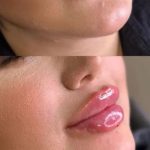 بوتاکس _فیلر_نخ_مزو _انزیم