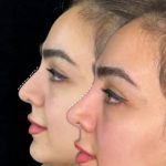 فیلر_نخ_بوتاکس