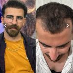 کاشت مو، ابرو،،ریش