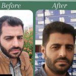 کاشت مو، ابرو،،ریش
