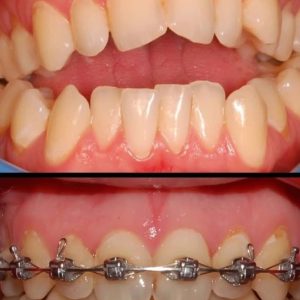 ارتودنسی از دم قسط، هرفک 55 میلیون (فقط تا 1 هفته)