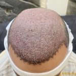 کاشت مو، ابرو،،ریش