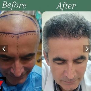 کاشت مو، ابرو،،ریش